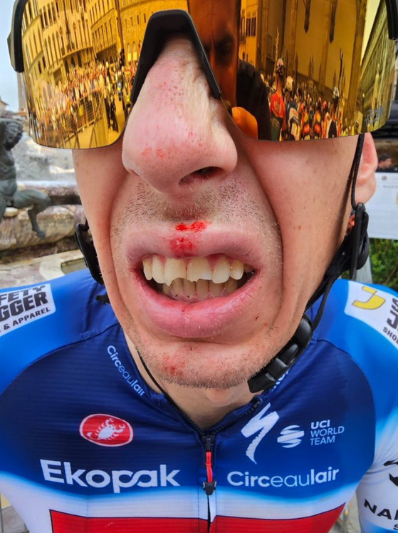 Le Tchèque Jan Hirt (Soudal Quick Step) et ses trois dents cassées avant la première étape du Tour de France - Photo : Twitter (X)/Soudal Quick Step